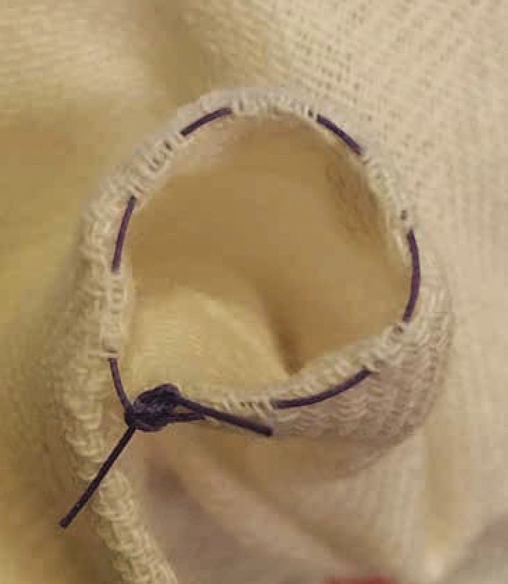 Bracket-like suture method: a novel, circular marked, simplest sided purse-string  suture technique for intracorporeal circular-stapled oesophagojejunostomy  during laparoscopic total gastrectomy | Langenbeck's Archives of Surgery