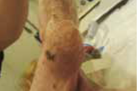 1. The soft tissue sarcoma.