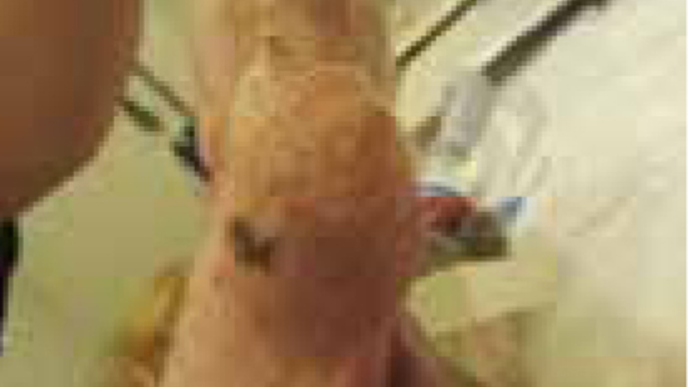 1. The soft tissue sarcoma.