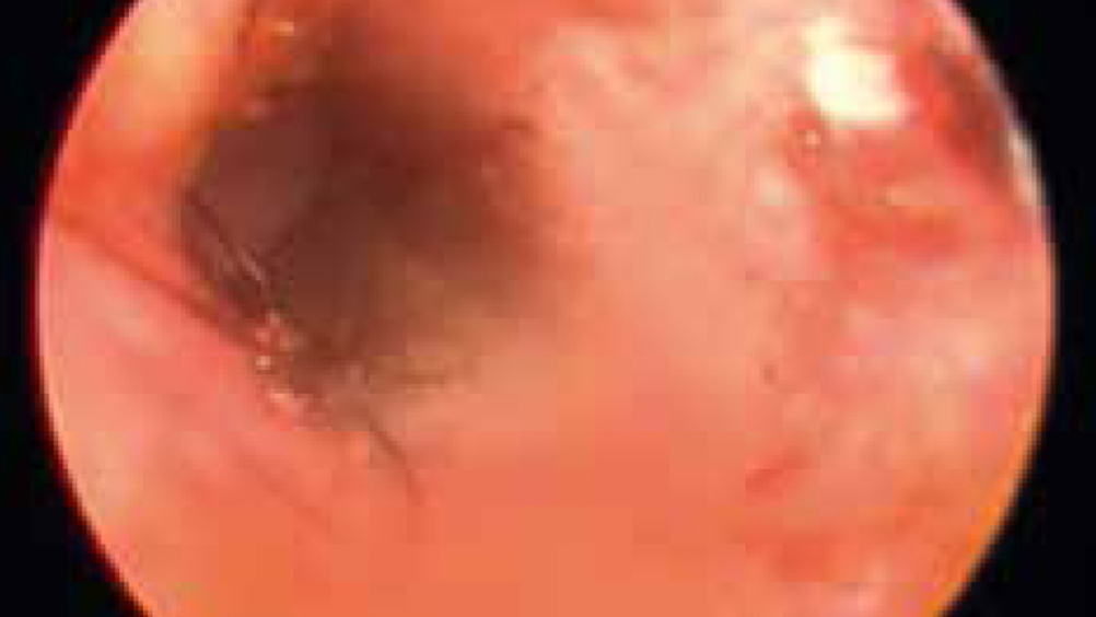 Figure 3. Typical appearance of ear canal in cases of infection due to Staphylococcus spp.