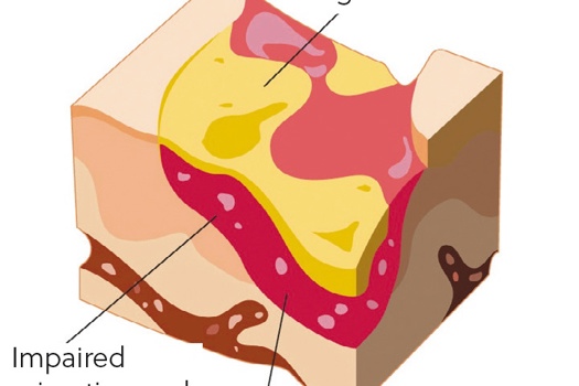 Figure 1. Biofilms act as a barrier to the wound and help the colony to defend itself against antimicrobial treatments and immune cells.