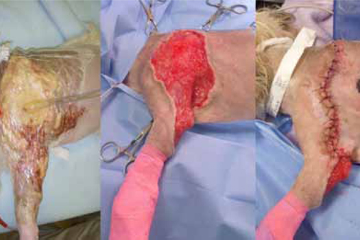 Figure 2. Negative pressure therapy.