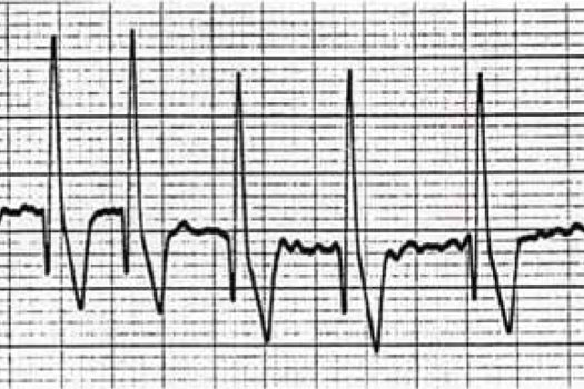 Figure 1. Electrocardiogram (ECG) showing atrial fibrillation in a Doberman. Heart rate is between 220–250 beats/min, note the lack of P waves and irregular rhythm. ECG courtesy of Simon Dennis.