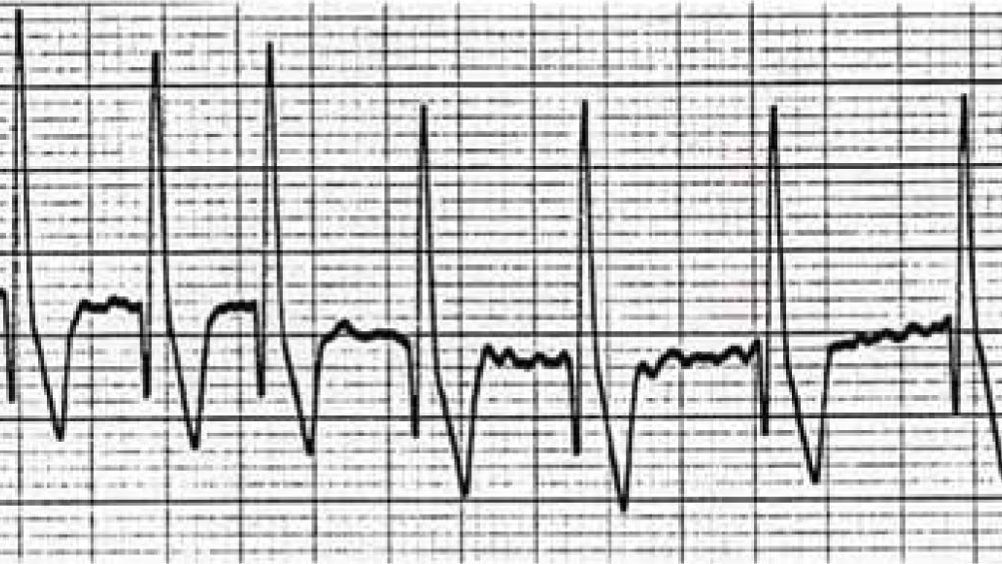 Figure 1. Electrocardiogram (ECG) showing atrial fibrillation in a Doberman. Heart rate is between 220–250 beats/min, note the lack of P waves and irregular rhythm. ECG courtesy of Simon Dennis.