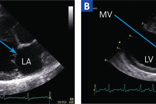 Figure 1. a) Echocardiography image showing a normal canine heart in a right parasternal long axis four chamber view. b) Echocardiography image showing a Cavalier King Charles Spaniel's heart at stage B2, in a right parasternal long axis four chamber view. Note the left-sided dilation and diseased mitral valve (arrowed)