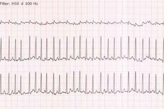 Figure 1. Electrocardiogram trace showing atrial fibrillation.